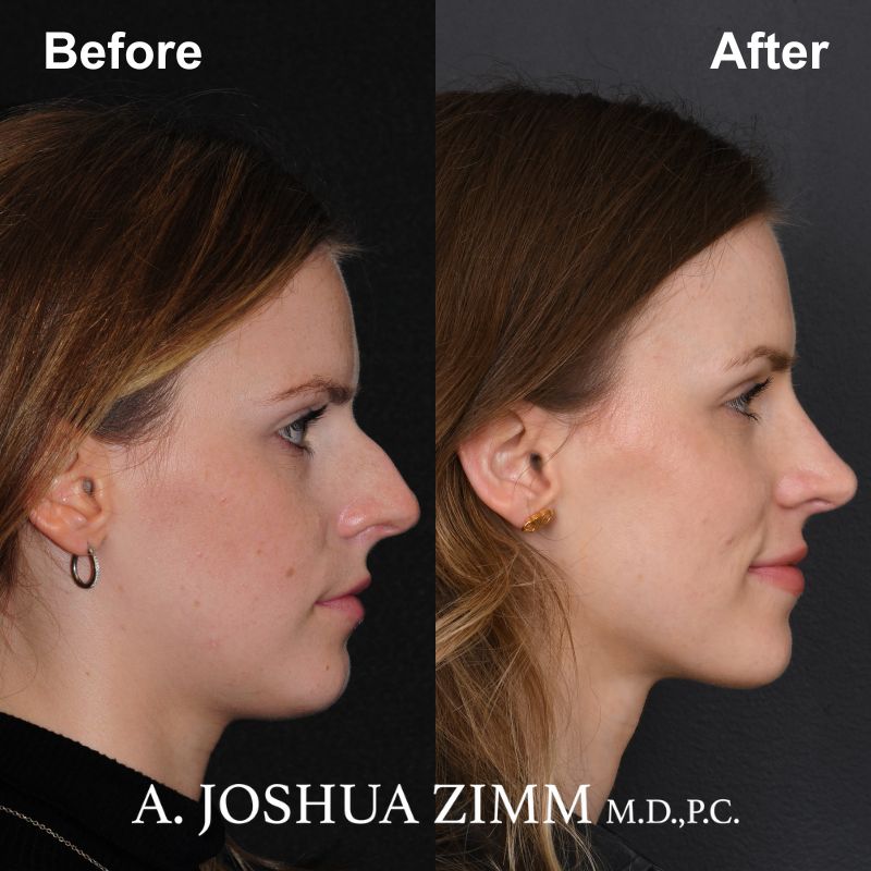 1 Rhinoplasty Before And After 8