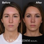 1 Rhinoplasty Before And After 9