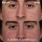 10 Rhinoplasty Before And After 2