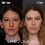 10 Rhinoplasty Before And After 3