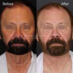 10mo 15d Post Direct Neck Lift FP Eyes Blurred 1