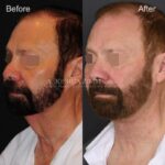 10mo 15d Post Direct Neck Lift L3.4V Eyes Blurred 1