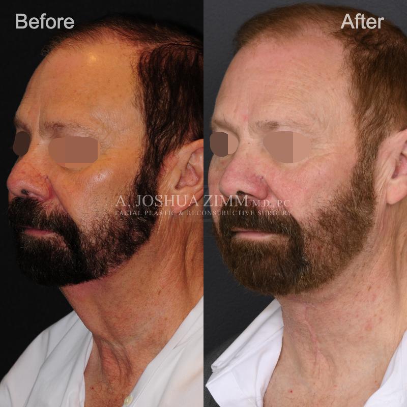 10mo 15d Post Direct Neck Lift L3.4V Eyes Blurred