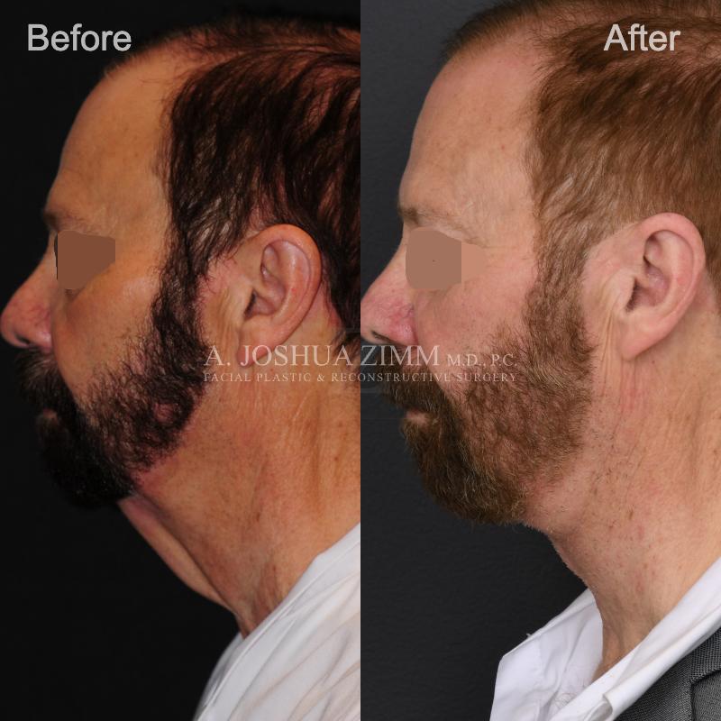 10mo 15d Post Direct Neck Lift LPNS Eyes Blurred 1