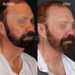 10mo 15d Post Direct Neck Lift R3.4V Eyes Blurred 1