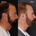 10mo 15d Post Direct Neck Lift RPNS Eyes Blurred 1