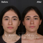 124 Frontal