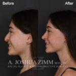 124 Left Lateral Smiling