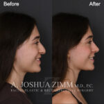 124 Rhight Lateral Smiling