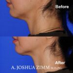 2 FaceTite AccuTite Before And Afte