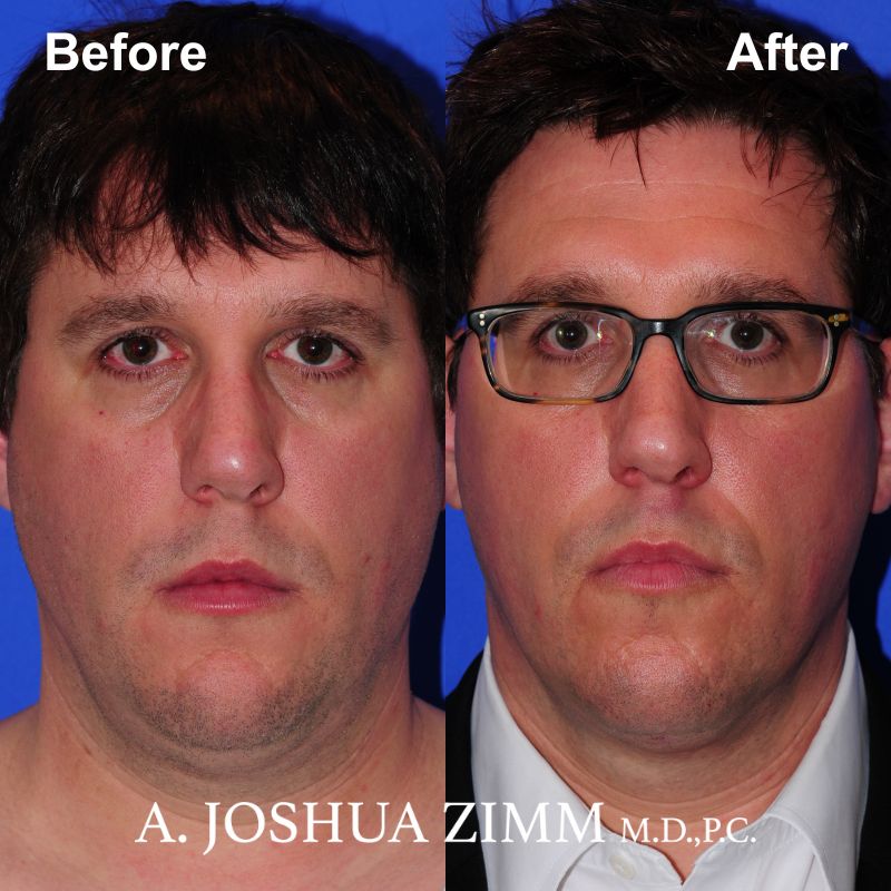 2 FaceTite AccuTite Before And After 1