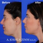 2 FaceTite AccuTite Before And After 2