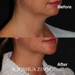 2 FaceTite AccuTite Before And After 3