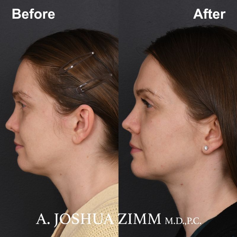2 FaceTite AccuTite Before And After