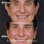 2 Otoplasty Before And After