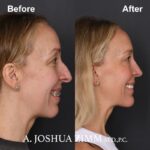 2 Chin Implant Before And After 1