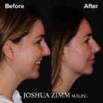 2 Chin Implant Before And After