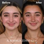 2 Chin Implant Before And After 2 1