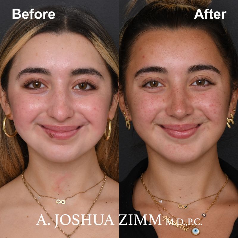 2 Chin Implant Before And After 2 1