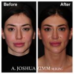 2 Chin Implant Before And After 2