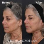 2 Facelift Before And After 1 1