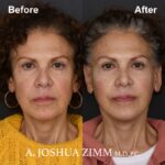 2 Facelift Before And After 2