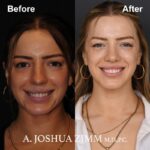 2 Revision Rhinoplasty 1