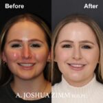 2 Revision Rhinoplasty