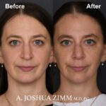 2 Revision Rhinoplasty 3