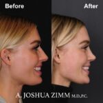 2 Rhinoplasty Before And After 1 1