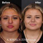 2 Rhinoplasty Before And After 1
