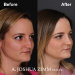 2 Rhinoplasty Before And After 10