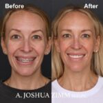2 Rhinoplasty Before And After 13