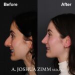 2 Rhinoplasty Before And After 15