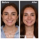 2 Rhinoplasty Before And After 16
