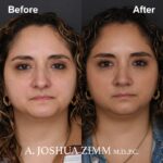 2 Rhinoplasty Before And After 18