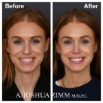 2 Rhinoplasty Before And After 20