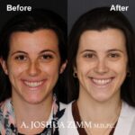 2 Rhinoplasty Before And After 21