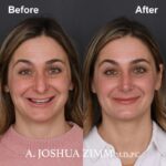 2 Rhinoplasty Before And After 22