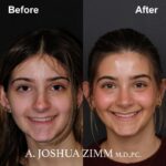 2 Rhinoplasty Before And After 25