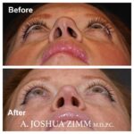 2 Rhinoplasty Before And After 27