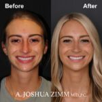 2 Rhinoplasty Before And After 28