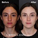 2 Rhinoplasty Before And After 29