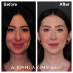 2 Rhinoplasty Before And After 30