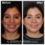 2 Rhinoplasty Before And After 33