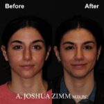 2 Rhinoplasty Before And After 34