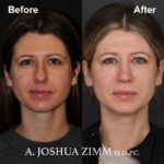 2 Rhinoplasty Before And After 36