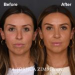 2 Rhinoplasty Before And After 38