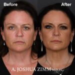 2 Rhinoplasty Before And After 4