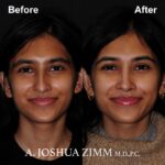 2 Rhinoplasty Before And After 40